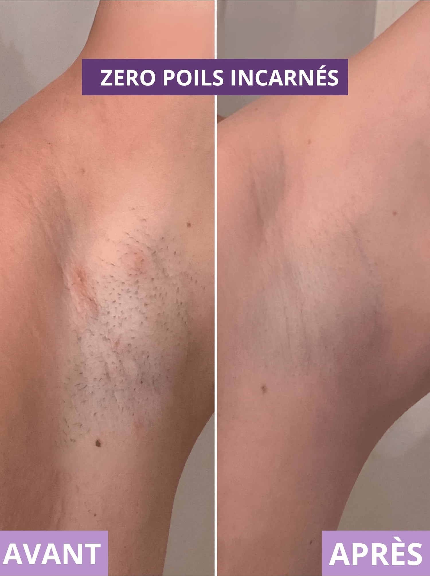 RASOIR 2 EN 1 - ZÉRO POILS INCARNÉS - Névea