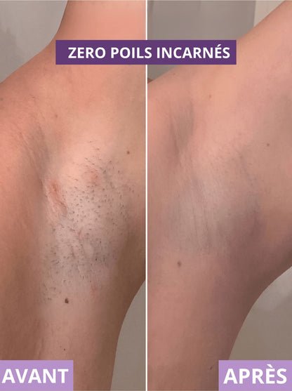 RASOIR 2 EN 1 - ZÉRO POILS INCARNÉS - Névea