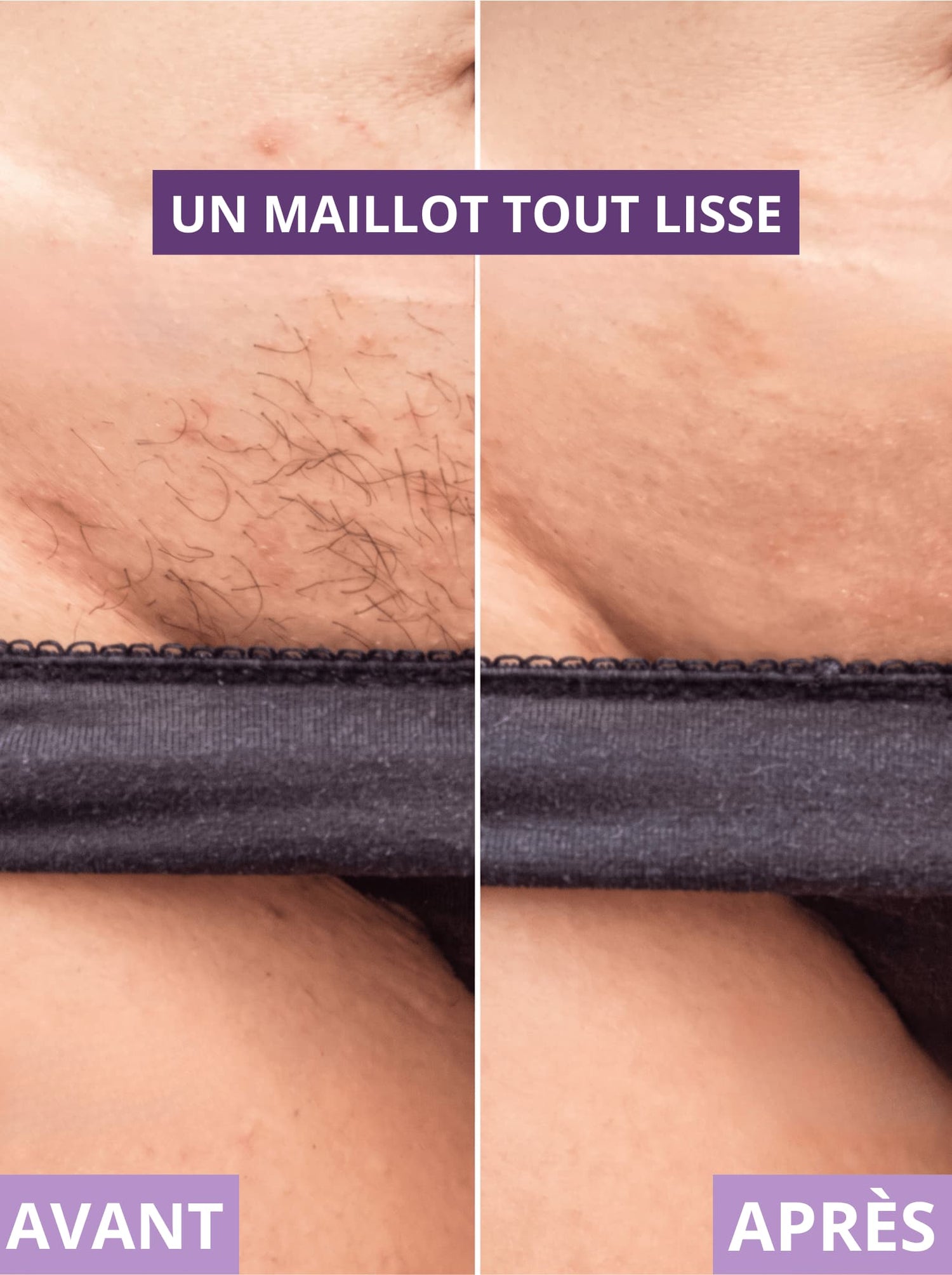 RASOIR 2 EN 1 - ZÉRO POILS INCARNÉS - Névea