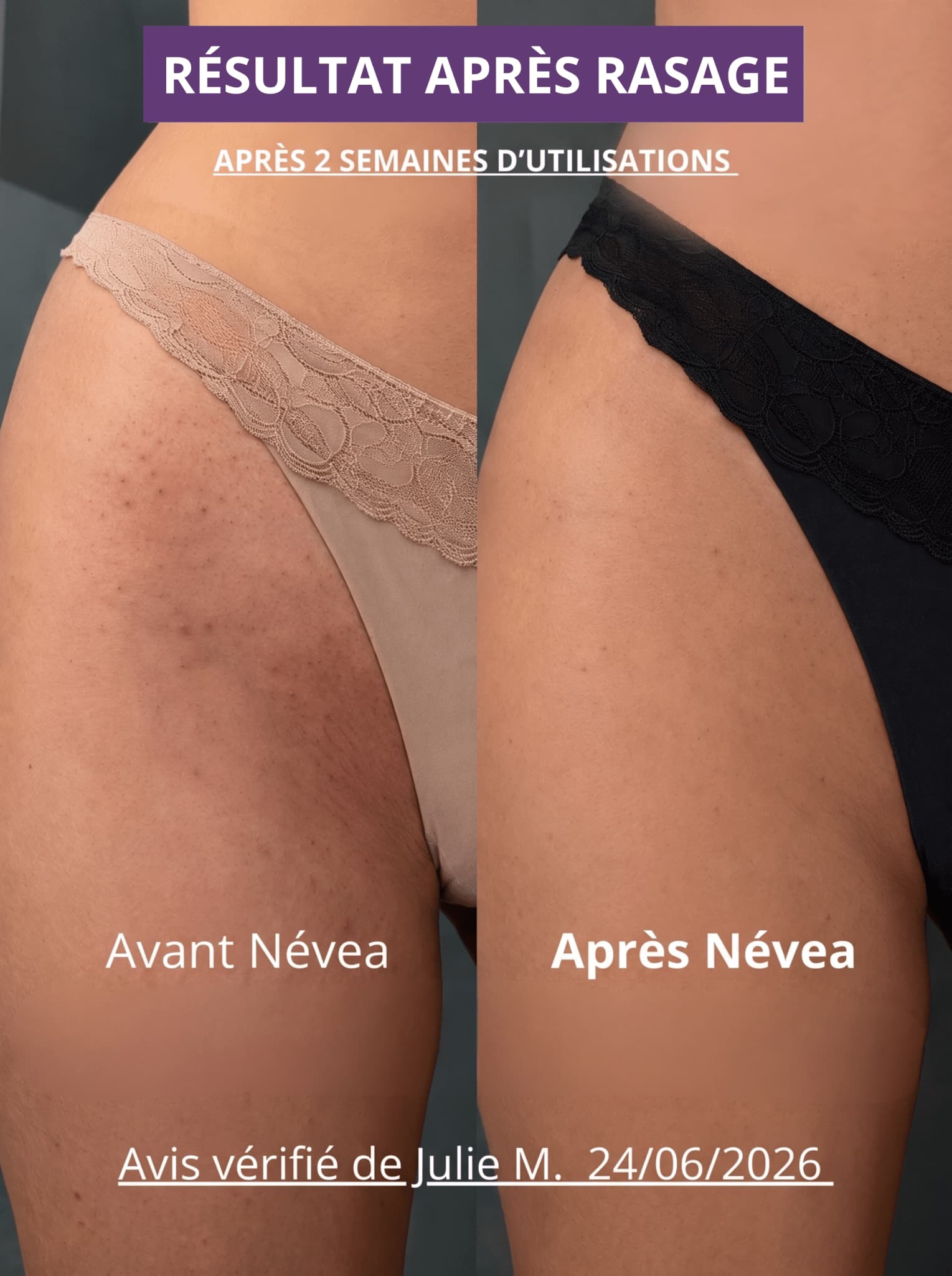 RASOIR 2 EN 1 - ZÉRO POILS INCARNÉS - Névea